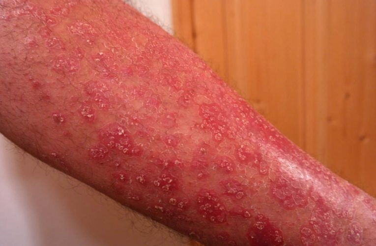 Natural Remedies for Psoriasis on Hands